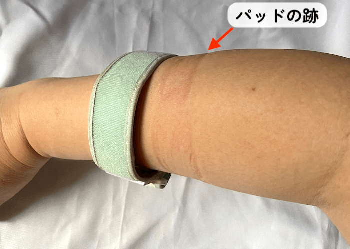 腕についた肘サポーターの跡