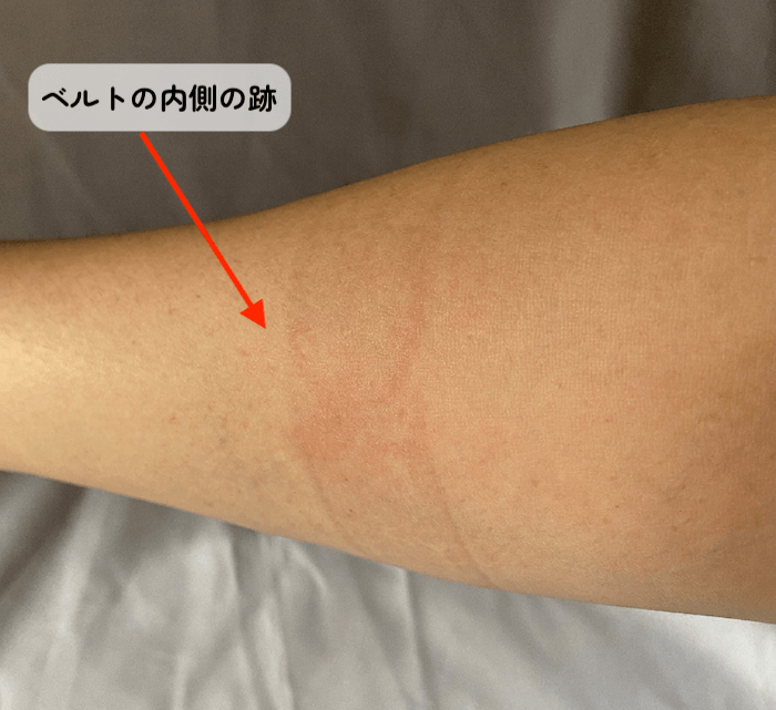 腕についた肘サポーターの跡
